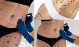 Vaser Liposuction ile Klasik Liposuction Arasındaki Fark Nedir?