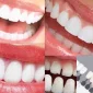 What is a Laminate Tooth in Aesthetic Dental Treatments?